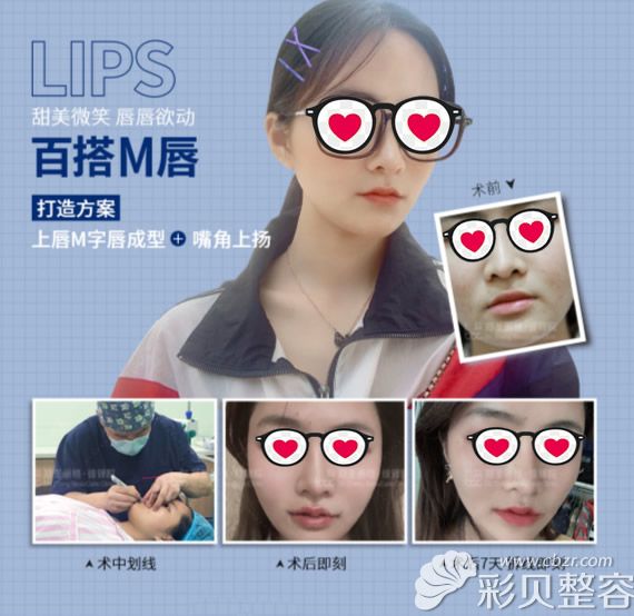 薄唇小仙女在重庆郑荃丽格做了M唇和嘴角上扬后嘴巴真好看!