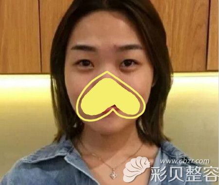 找洛阳莱尔美刘战辉做眼睛整形前照片