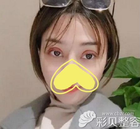 洛阳莱尔美刘战辉给我做全切双眼皮术后第7天效果图