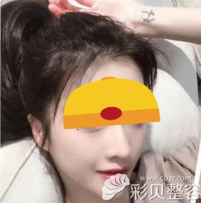 洛阳莱尔美刘战辉做美国舒铂超肋鼻综合手术恢复半年效果照片