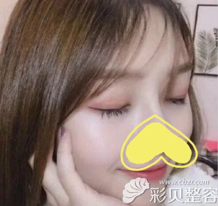 洛阳莱尔美刘战辉给我做全切双眼皮术后三个月效果照片