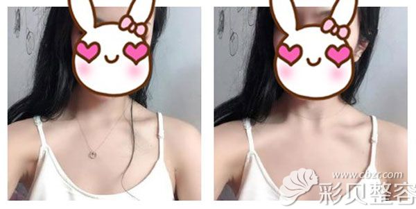 隆胸手术前的照片