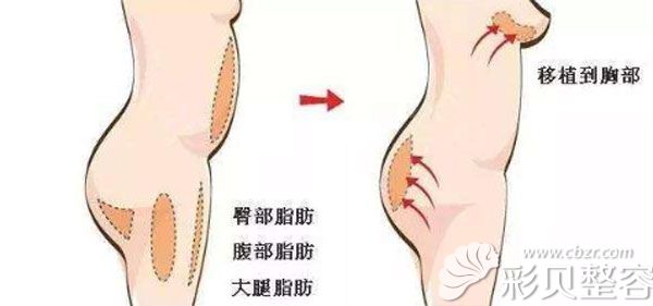 自体脂肪隆胸200cc有多大