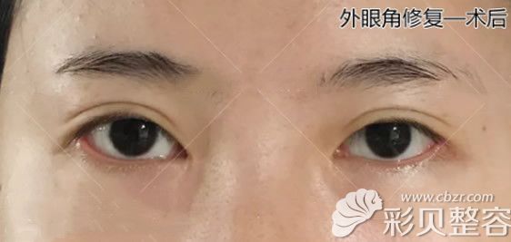 北京美莱杜园园给我外眼角修复三个月后效果