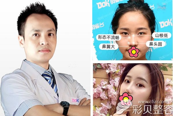 成都铜雀台雷刚整鼻子效果