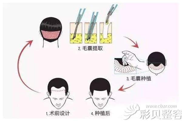 姚宝林医生做毛发移植过程