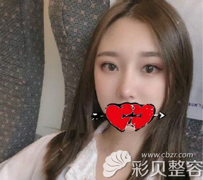 美国舒铂超肋骨一年效果图片