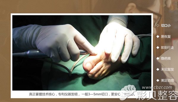 5D微孔弧祛大脚骨技术优势