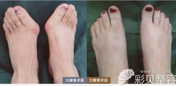 马桂文大脚骨手术前后对比照片
