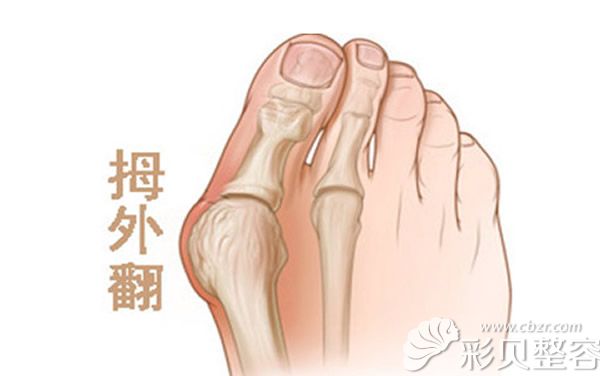 什么是大脚骨拇指外翻