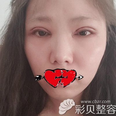 潍坊华美医院任院长割双眼皮术后第3天照片
