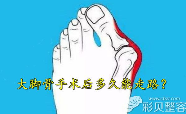 有人​做微创大脚骨手术42天能小跑,她术后半年还无法走路!