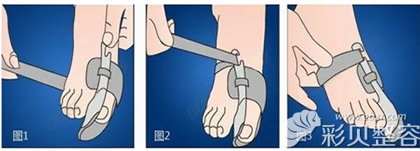 传统大脚骨手术需要用钢板钢钉固定