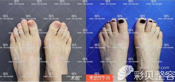 北京圣嘉新拇外翻手术案例