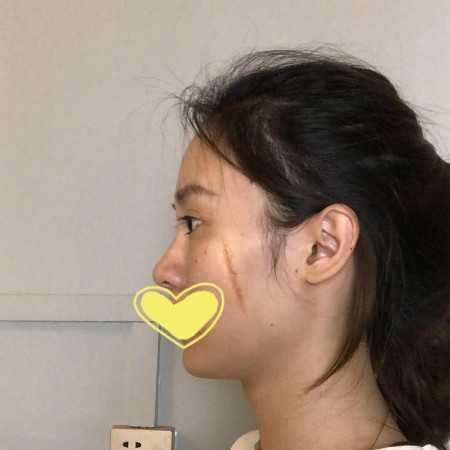 成都医大疤痕研究院微晶祛疤很靠谱的,治疗前后对比变化大