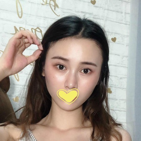 成都医大疤痕研究院微晶祛疤很靠谱的,治疗前后对比变化大