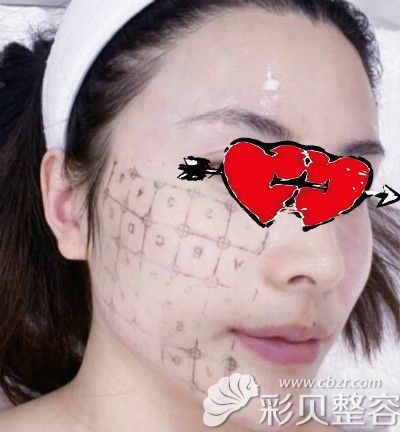 在杭州yestar做热玛吉全脸术后即刻效果图片