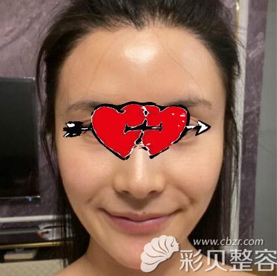 陪朋友去艺星做了热玛吉全脸,才清楚杭州哪里做热玛吉正规