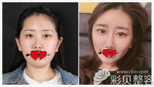 北京美莱热玛吉全脸除皱真人案例效果