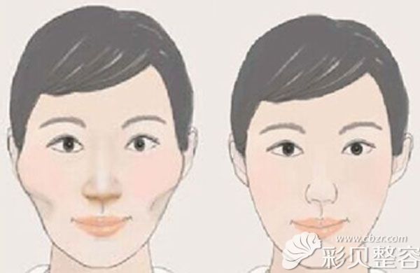 脸太宽了想要改变脸型只能磨骨