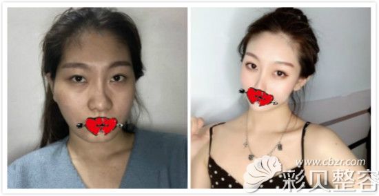 在杭州美天美整形做脸部埋线提升效果对比照片