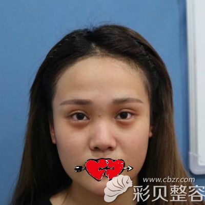 杭州格莱美汪云锋医生给我做鼻子前照片