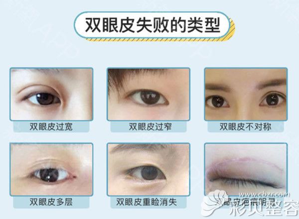 双眼皮失败的图片