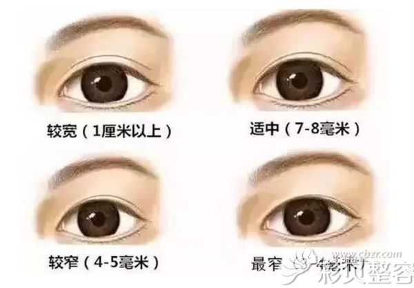 怎样判断双眼皮割窄了