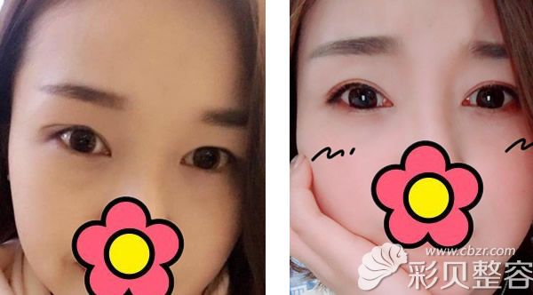 双眼皮割窄了二次加宽修复图