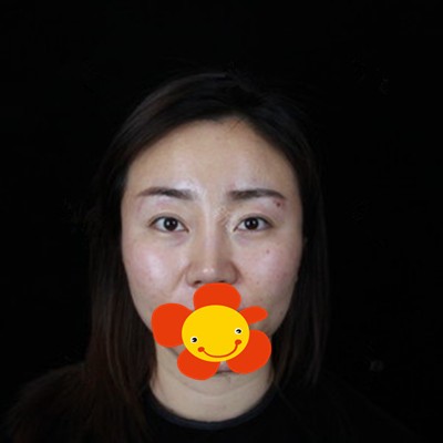 在潍坊坤娜做SVF黄金脂肪胶移植丰全脸改善了我面部凹陷