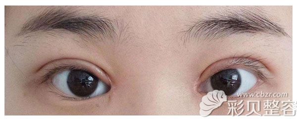 割双眼皮失败睫毛外翻
