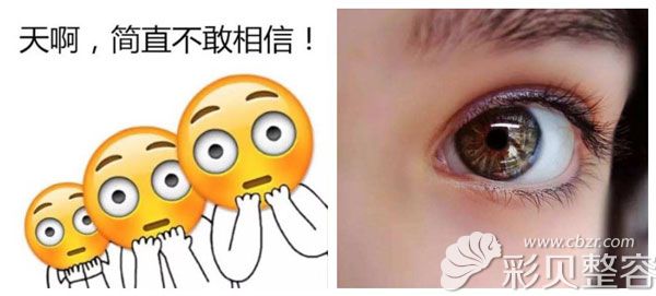 割双眼皮导致睫毛外翻的原因