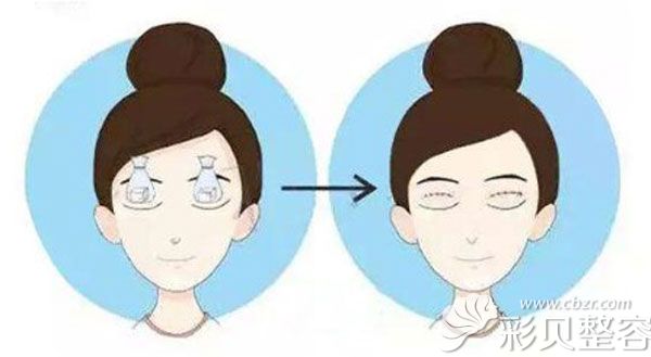 双眼皮去皮过多导致睫毛外翻该怎么补救