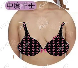 隆胸假体180cc做出来的效果不一定比250cc的小,180cc也能做出C杯