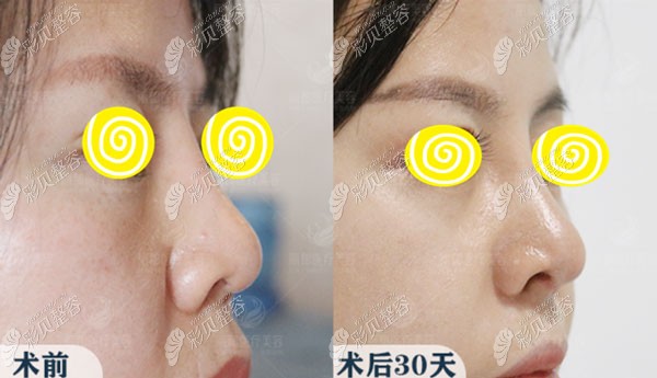 北京丽都吴玉家修复鼻孔不对称、外露的案例图