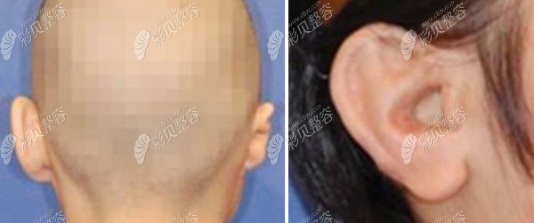 想矫正先天性耳廓畸形?北京丽都Medpor支架耳再造术为你修复