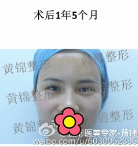 宁波整形外科医院黄锦医生,给我做全脸脂肪填充1年5个月了!