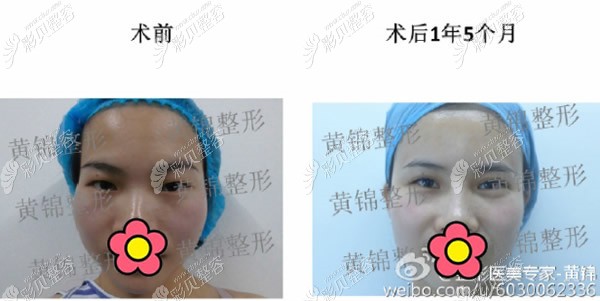 宁波整形外科医院黄锦医生全脸脂肪填充案例