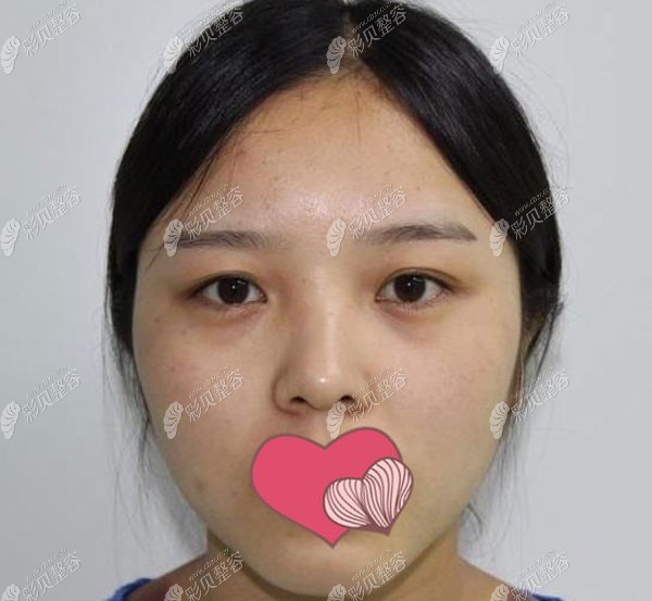 在郑州缔莱美整形割双眼皮手术前