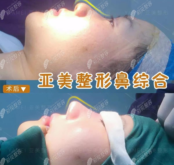 金华亚美刘政院长肋骨鼻综合术后即刻对比照片