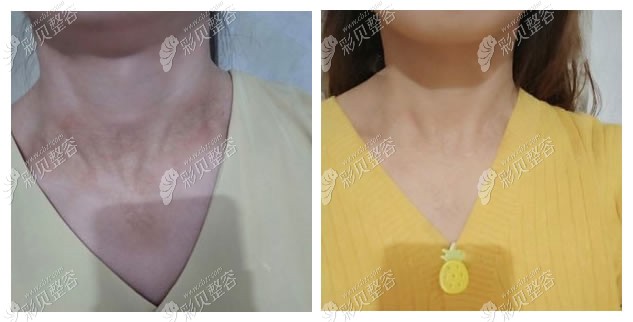北京国丹皮肤医院做激光祛疤的案例效果图