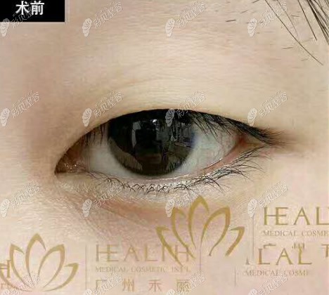 我在广州禾丽整形门诊部割双眼皮前