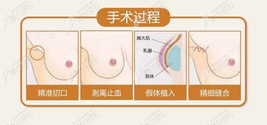 隆胸手术过程图