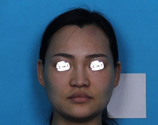 6月5号在北京美憬做面部埋线提升,一边用4根大V线后脸变小了