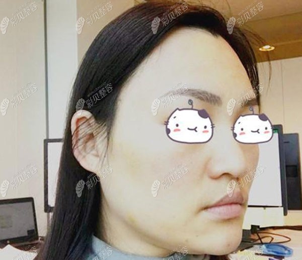 埋线提升术后第10天肿胀轻