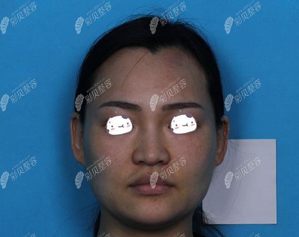 做全脸埋线提升手术前