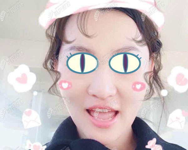 在北京美憬整形做埋线提升5个月的恢复效果