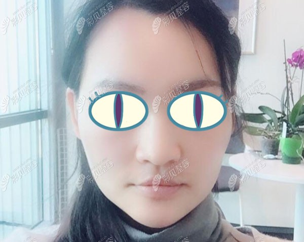 脸部埋线提升一个月定型，皮肤紧实