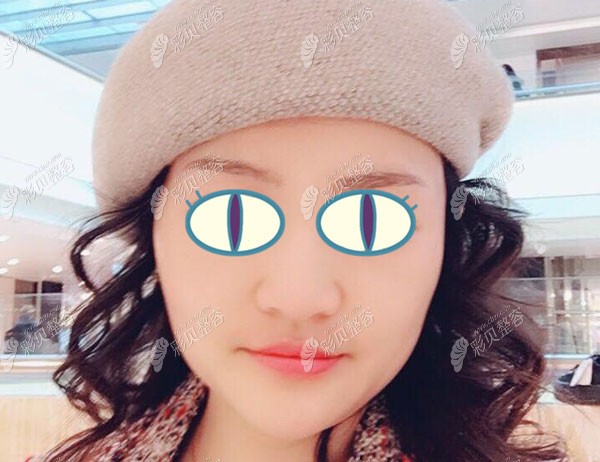 埋线提升4个月的恢复效果图