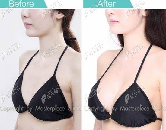 Santiphap Sae-ung院长做曼托假体丰胸案例